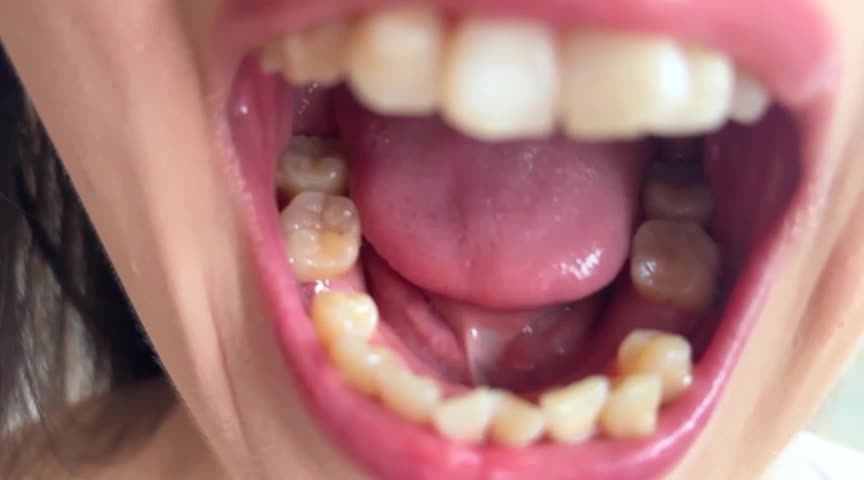 街角で声をかけて口内観察させてもらう ファーストフード店パート みおりさん